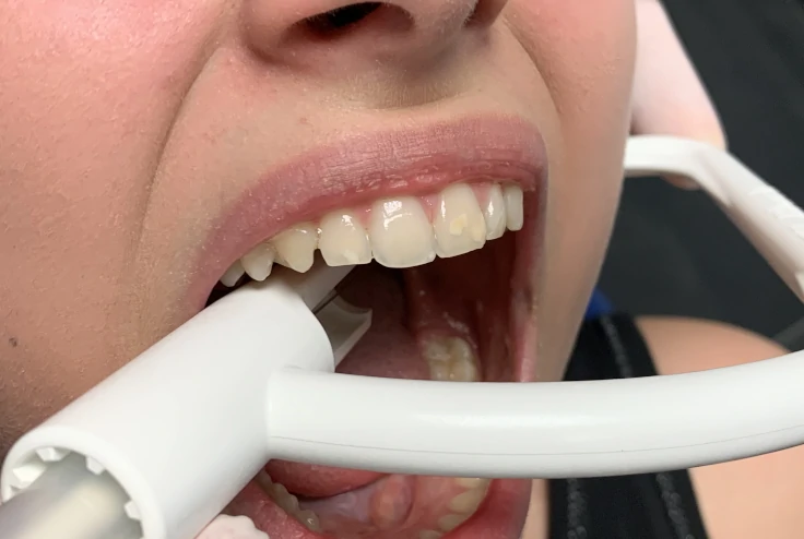 Il tubo viene premuto contro la superficie occlusale dei denti premolari mascellari. 