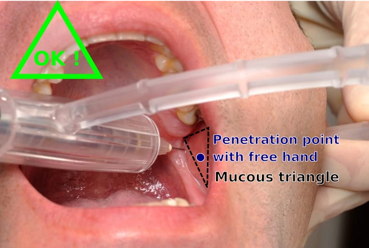 Attention : for some patients, the penetration point may look upper than usual (for free hands anesthesia), but the injection point of EZ-Block® is calculated. It will be optimal.